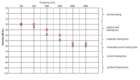 Hearing Chart with high frequency hearing loss